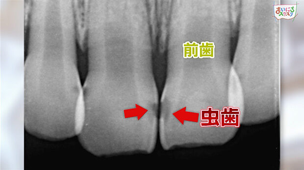 虫歯