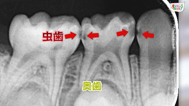 虫歯